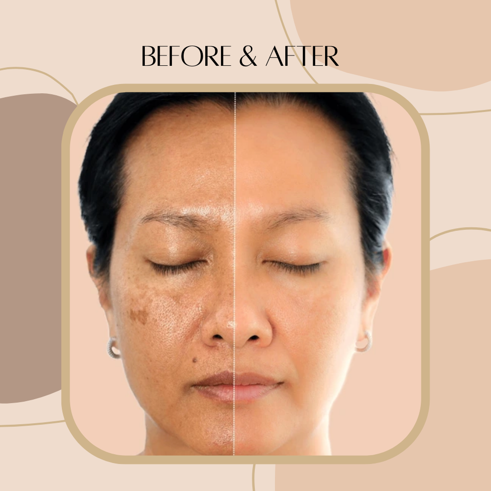 Britain's Beauty Dark Spot Corrector Oil – Fade Acne Marks & Blemishes, Even Skin Tone, Natural Hydration for Face & Body – 1 oz / 30ml