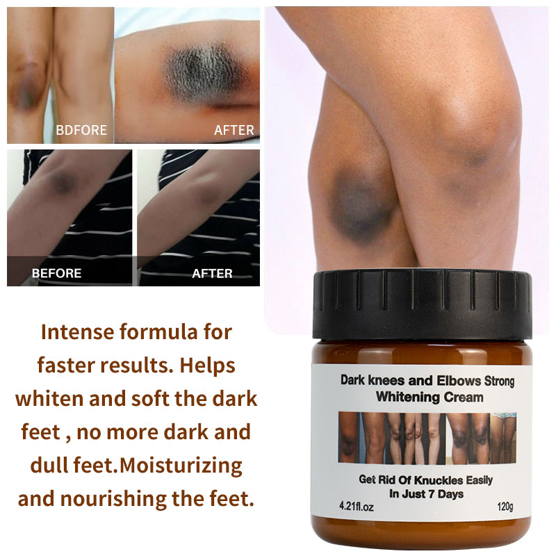 Dark Knees and Elbows Strong Whitening Cream - Powerful Skin Lightening, Moisturizing Formula for Dark Patches, Knuckles, and Elbows - Gentle, Effective Whitening Cream - 120g
