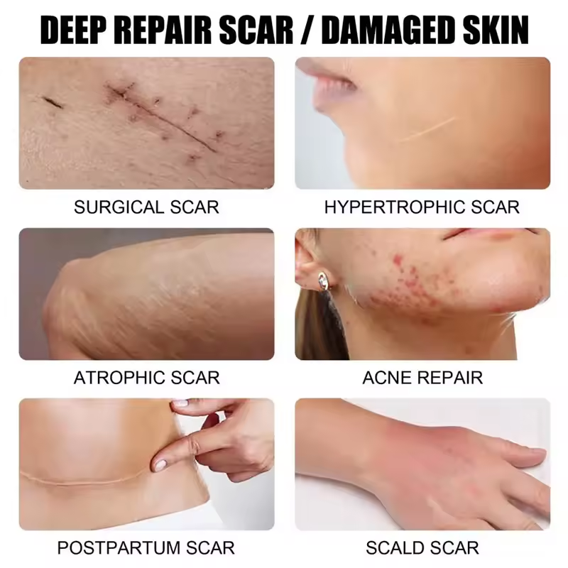 Advanced Scar Removal Cream - Effective Skin Repair for Surgical, Acne, and Stretch Marks