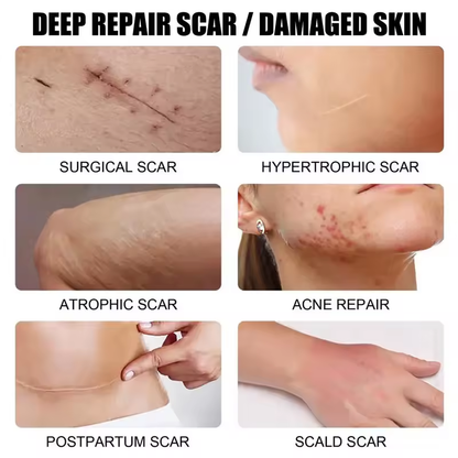 Advanced Scar Removal Cream - Effective Skin Repair for Surgical, Acne, and Stretch Marks