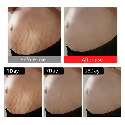 Advanced Stretch Mark Removal Oil - Skin Care Oil for Scars, Pregnancy Stretch Marks, and Uneven Skin Tone - 121mL