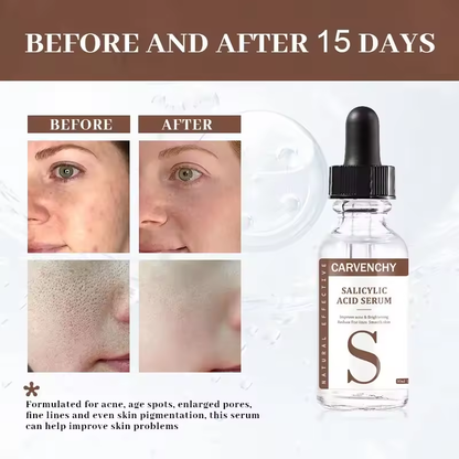 Salicylic Acid Serum for Clear Skin - Natural Acne Treatment with Glycolic, 30ml (1.01 fl oz)