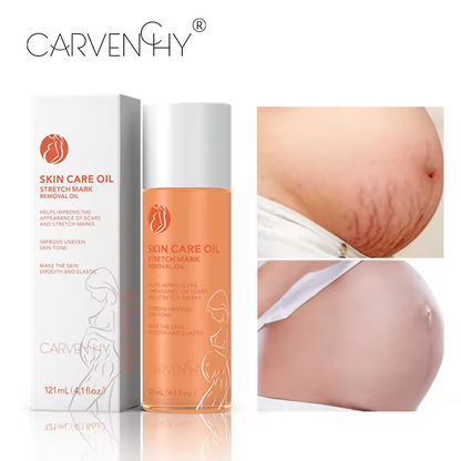 Advanced Stretch Mark Removal Oil - Skin Care Oil for Scars, Pregnancy Stretch Marks, and Uneven Skin Tone - 121mL