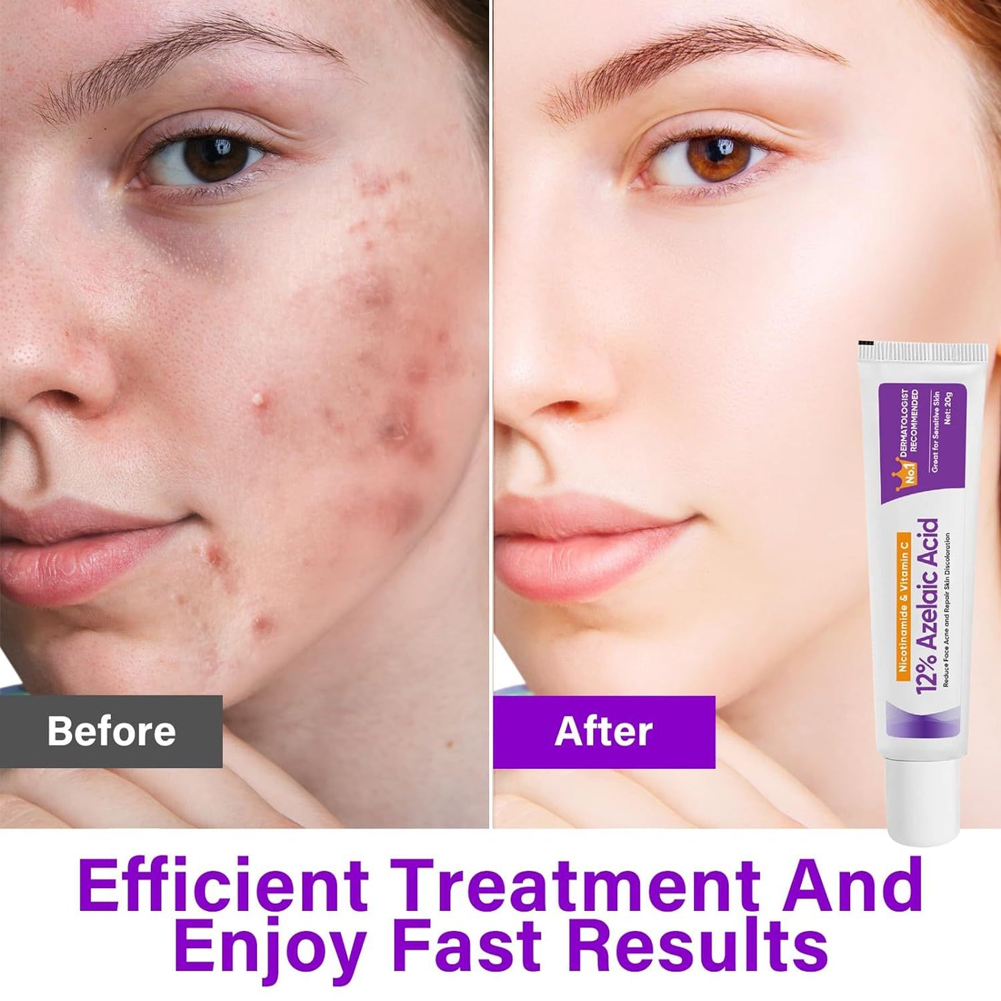 NourishMax Skin Clarifying 12% Azelaic Acid Cream - Dermatologist Recommended, Reduce Acne, Rosacea, and Discoloration, Face & Neck Brightening Formula, 20g