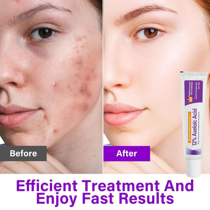 NourishMax Skin Clarifying 12% Azelaic Acid Cream - Dermatologist Recommended, Reduce Acne, Rosacea, and Discoloration, Face & Neck Brightening Formula, 20g